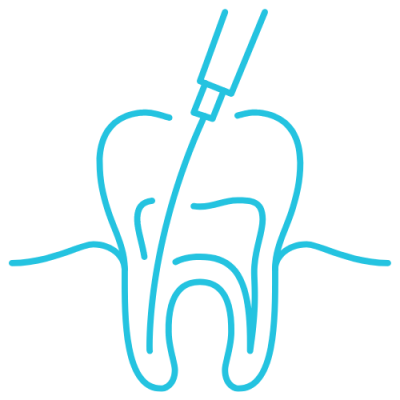 Root Canal Treatment (RCT) 根管治疗 - KLIDC